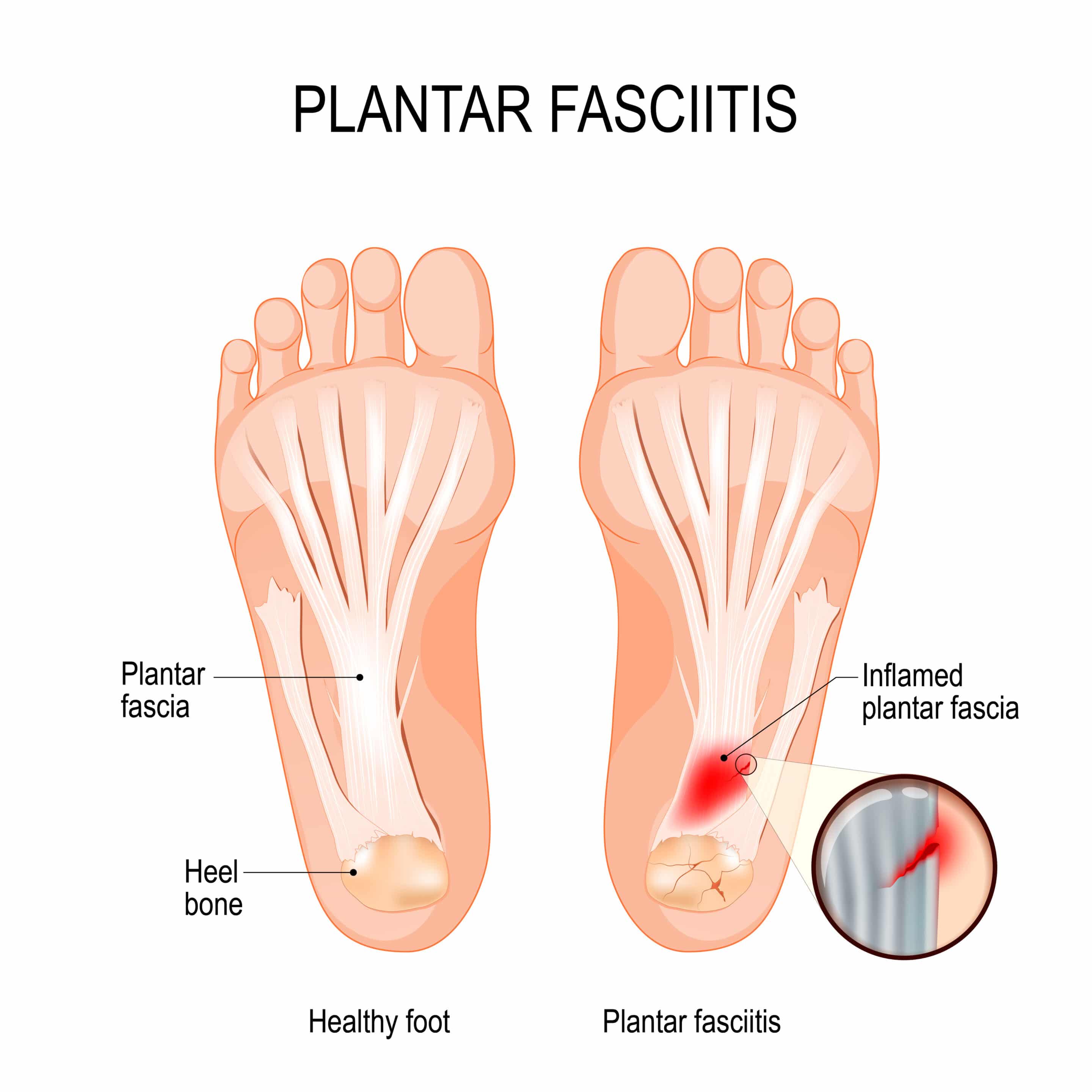 Plantar fasciitis. disorder of the connective tissue which suppo