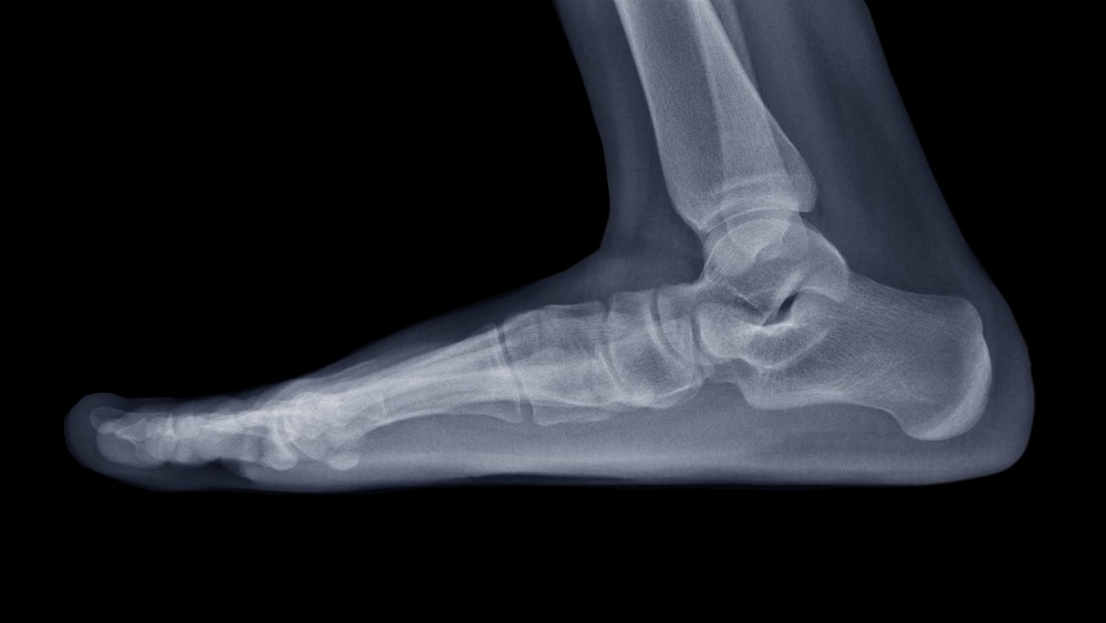 X-ray shows what flat feet look like inside of foot