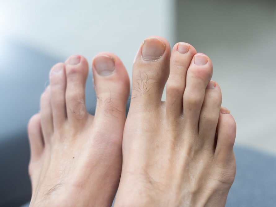 Feet after toenail fungus treatments