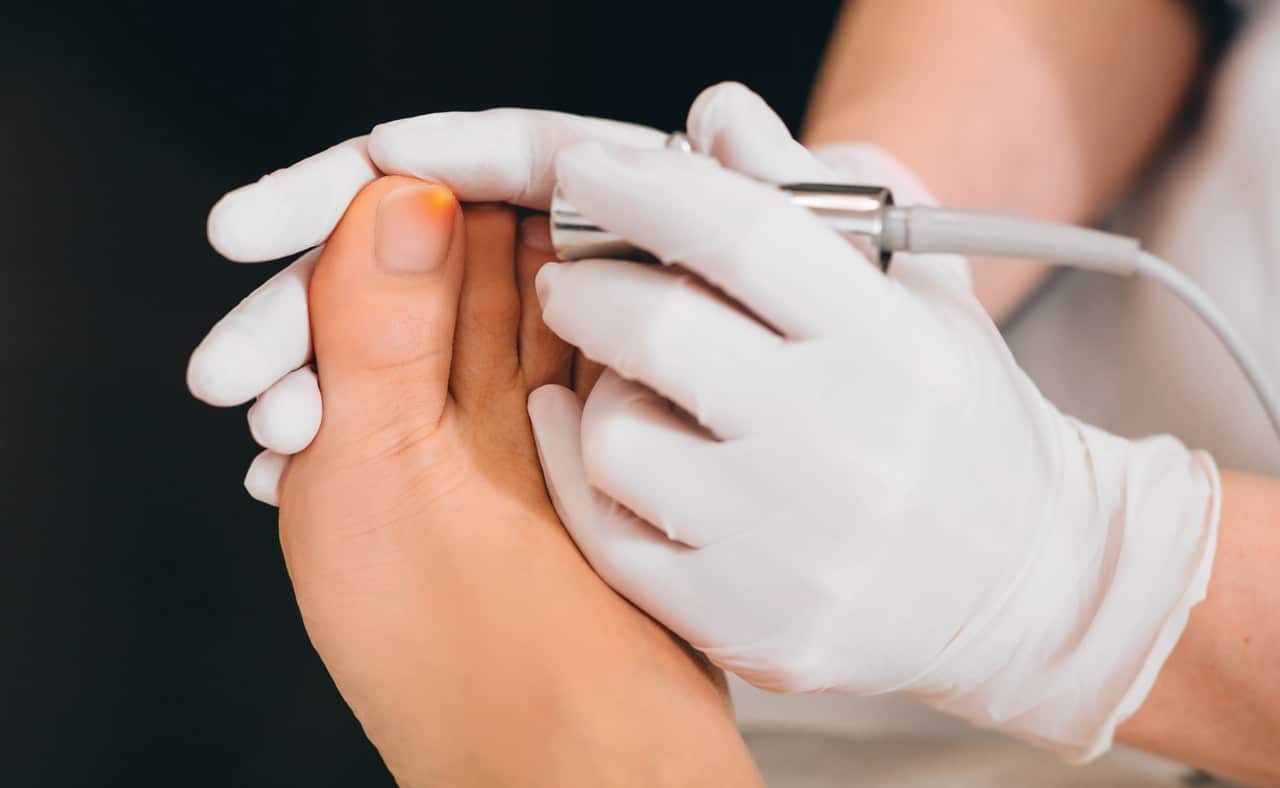 laser treatment for fungal nail